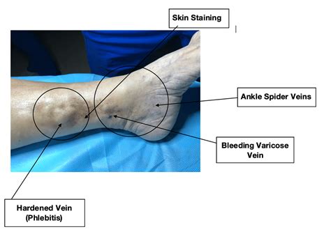 vein hard after blood test|red spots on veins.